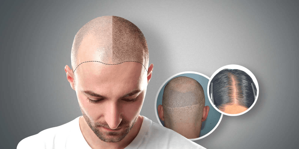 Scalp Micropigmentation